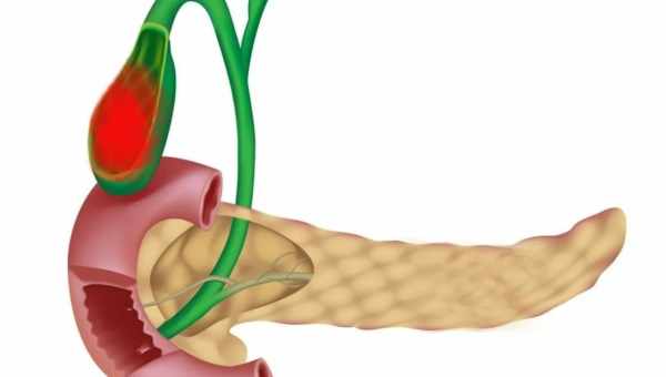 Воспаление желчного пузыря – симптомы и лечение