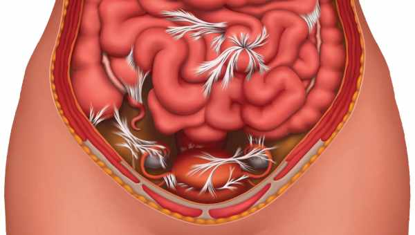 Как лечить спайки кишечника