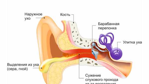 Как лечить отит