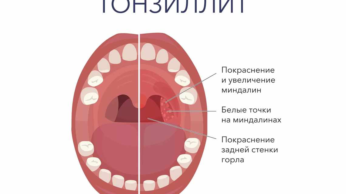 Как лечить ангину в домашних условиях