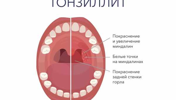 Как лечить ангину в домашних условиях