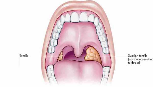 Как лечить хронический тонзиллит
