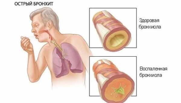 Как лечить гнойный кашель