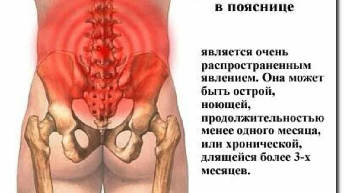 Болит поясница, что делать