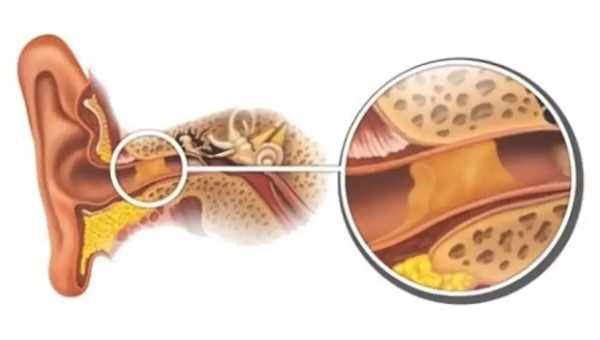 Пробка в ухе – что делать?