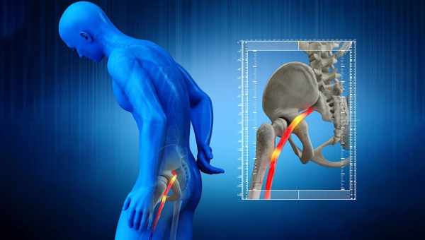 Как вылечить седалищный нерв