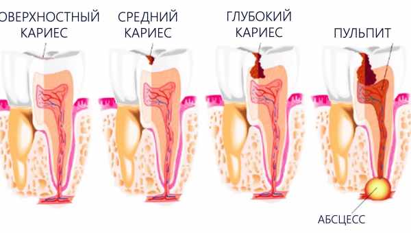 Что такое пульпит