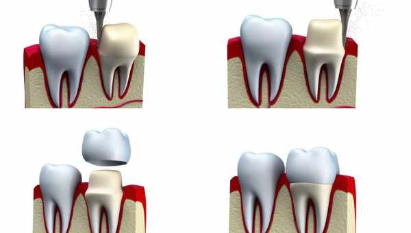 Как ставят коронку на зуб