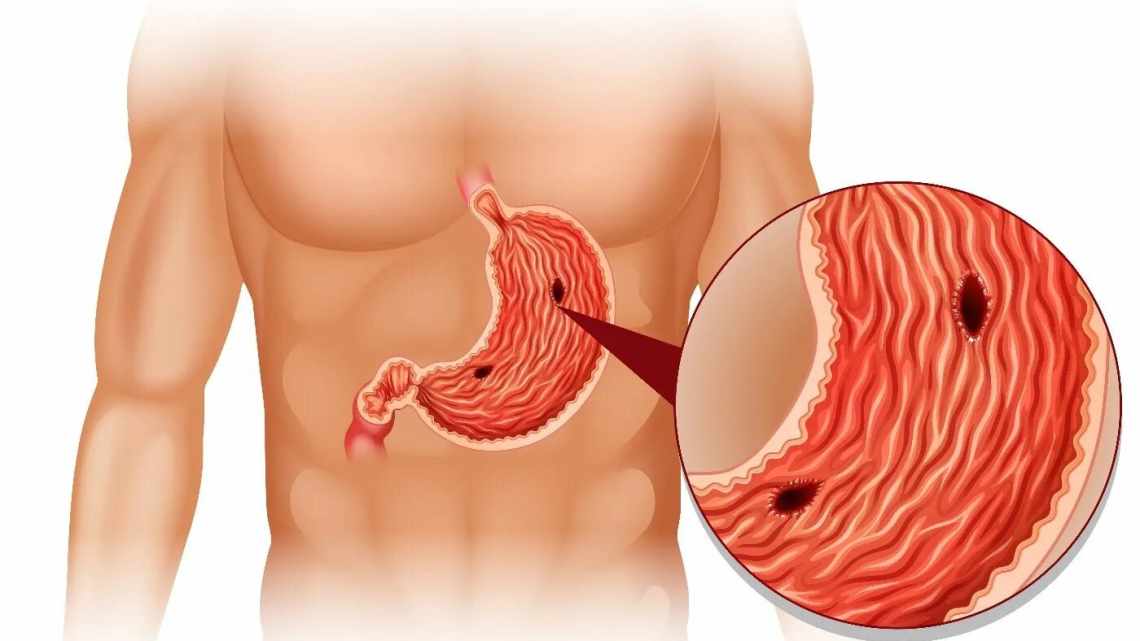 Как не навредить своему организму при лечении язвы желудка