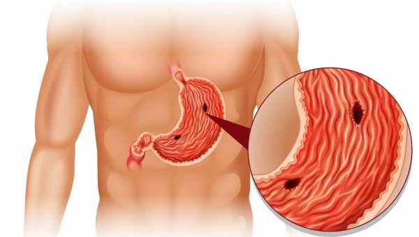 Как не навредить своему организму при лечении язвы желудка