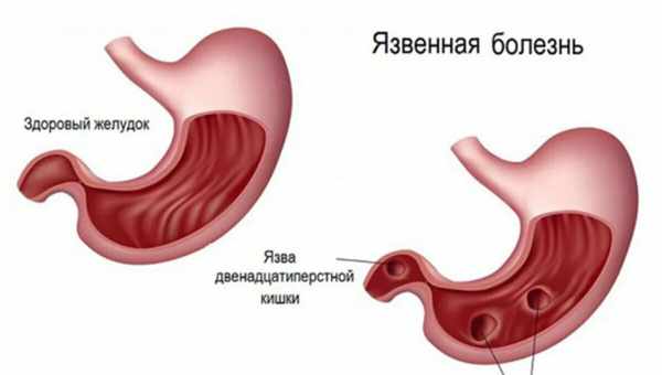 Почему возникает язва желудка, как ее распознать и чем она опасна